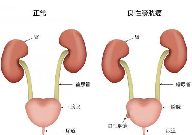 天津治疗膀胱癌最有效的老中医